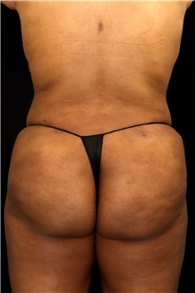 Buttock Lift with Augmentation After Photo by Landon Pryor, MD, FACS; Rockford, IL - Case 45102