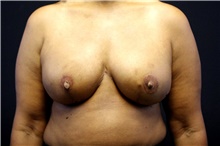 Breast Reconstruction After Photo by Landon Pryor, MD, FACS; Rockford, IL - Case 45104
