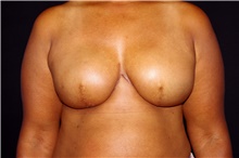 Breast Reconstruction Before Photo by Landon Pryor, MD, FACS; Rockford, IL - Case 45104