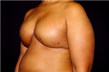 Breast Reconstruction Before Photo by Landon Pryor, MD, FACS; Rockford, IL - Case 45104