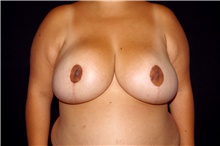 Breast Reduction After Photo by Landon Pryor, MD, FACS; Rockford, IL - Case 45105