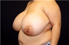 Breast Reduction Before Photo by Landon Pryor, MD, FACS; Rockford, IL - Case 45105