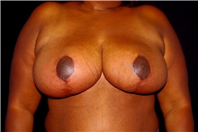 Breast Reduction After Photo by Landon Pryor, MD, FACS; Rockford, IL - Case 45106