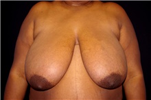 Breast Reduction Before Photo by Landon Pryor, MD, FACS; Rockford, IL - Case 45106
