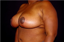 Breast Reduction After Photo by Landon Pryor, MD, FACS; Rockford, IL - Case 45106