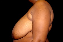 Breast Reduction Before Photo by Landon Pryor, MD, FACS; Rockford, IL - Case 45106