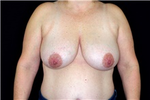 Breast Reduction Before Photo by Landon Pryor, MD, FACS; Rockford, IL - Case 45107