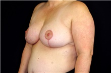 Breast Reduction After Photo by Landon Pryor, MD, FACS; Rockford, IL - Case 45107