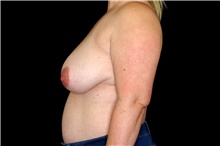 Breast Reduction Before Photo by Landon Pryor, MD, FACS; Rockford, IL - Case 45107
