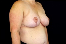Breast Reduction After Photo by Landon Pryor, MD, FACS; Rockford, IL - Case 45107