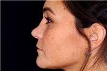 Dermal Fillers Before Photo by Landon Pryor, MD, FACS; Rockford, IL - Case 45108