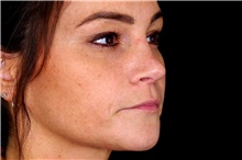 Dermal Fillers Before Photo by Landon Pryor, MD, FACS; Rockford, IL - Case 45108