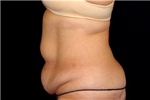 Tummy Tuck Before Photo by Landon Pryor, MD, FACS; Rockford, IL - Case 45109