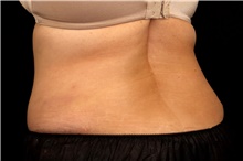 Tummy Tuck After Photo by Landon Pryor, MD, FACS; Rockford, IL - Case 45109