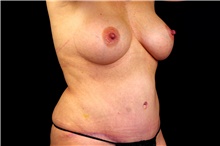 Tummy Tuck After Photo by Landon Pryor, MD, FACS; Rockford, IL - Case 45112