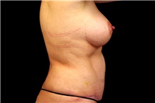 Tummy Tuck After Photo by Landon Pryor, MD, FACS; Rockford, IL - Case 45112