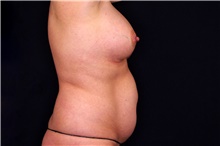 Tummy Tuck Before Photo by Landon Pryor, MD, FACS; Rockford, IL - Case 45112