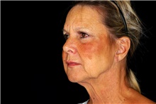 Facelift Before Photo by Landon Pryor, MD, FACS; Rockford, IL - Case 45113