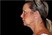 Facelift Before Photo by Landon Pryor, MD, FACS; Rockford, IL - Case 45113