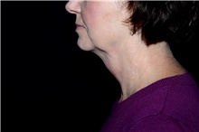 Liposuction After Photo by Landon Pryor, MD, FACS; Rockford, IL - Case 45114