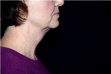 Liposuction After Photo by Landon Pryor, MD, FACS; Rockford, IL - Case 45114