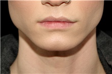 Lip Augmentation/Enhancement Before Photo by Landon Pryor, MD, FACS; Rockford, IL - Case 45115