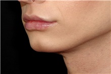 Lip Augmentation/Enhancement After Photo by Landon Pryor, MD, FACS; Rockford, IL - Case 45115