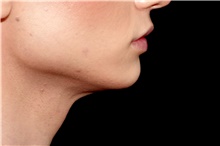 Lip Augmentation/Enhancement After Photo by Landon Pryor, MD, FACS; Rockford, IL - Case 45115