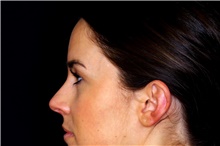 Ear Surgery Before Photo by Landon Pryor, MD, FACS; Rockford, IL - Case 45116