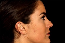 Ear Surgery After Photo by Landon Pryor, MD, FACS; Rockford, IL - Case 45116