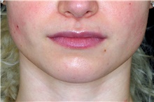 Lip Augmentation/Enhancement Before Photo by Landon Pryor, MD, FACS; Rockford, IL - Case 45119