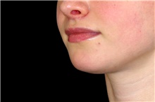 Lip Augmentation/Enhancement After Photo by Landon Pryor, MD, FACS; Rockford, IL - Case 45119