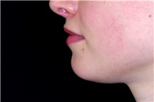 Lip Augmentation/Enhancement After Photo by Landon Pryor, MD, FACS; Rockford, IL - Case 45119