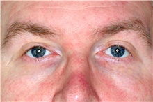 Eyelid Ptosis Repair After Photo by Landon Pryor, MD, FACS; Rockford, IL - Case 45126
