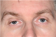 Eyelid Ptosis Repair Before Photo by Landon Pryor, MD, FACS; Rockford, IL - Case 45126