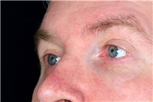 Eyelid Ptosis Repair After Photo by Landon Pryor, MD, FACS; Rockford, IL - Case 45126