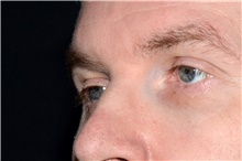 Eyelid Ptosis Repair Before Photo by Landon Pryor, MD, FACS; Rockford, IL - Case 45126