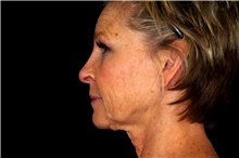 Facelift Before Photo by Landon Pryor, MD, FACS; Rockford, IL - Case 45128