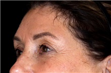 Eyelid Surgery After Photo by Landon Pryor, MD, FACS; Rockford, IL - Case 45130