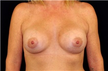 Breast Augmentation After Photo by Landon Pryor, MD, FACS; Rockford, IL - Case 45131