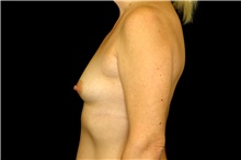 Breast Augmentation Before Photo by Landon Pryor, MD, FACS; Rockford, IL - Case 45131