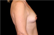 Breast Augmentation Before Photo by Landon Pryor, MD, FACS; Rockford, IL - Case 45131