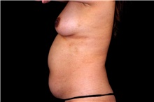 Tummy Tuck Before Photo by Landon Pryor, MD, FACS; Rockford, IL - Case 45133