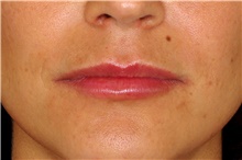 Lip Augmentation/Enhancement After Photo by Landon Pryor, MD, FACS; Rockford, IL - Case 45136