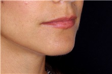 Lip Augmentation/Enhancement Before Photo by Landon Pryor, MD, FACS; Rockford, IL - Case 45136
