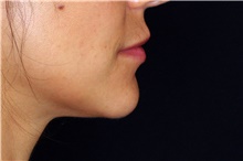 Lip Augmentation/Enhancement After Photo by Landon Pryor, MD, FACS; Rockford, IL - Case 45136