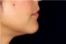 Lip Augmentation/Enhancement Before Photo by Landon Pryor, MD, FACS; Rockford, IL - Case 45136