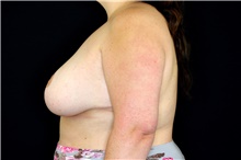 Breast Augmentation After Photo by Landon Pryor, MD, FACS; Rockford, IL - Case 45137