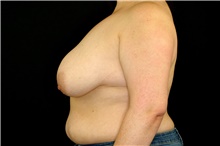 Breast Augmentation Before Photo by Landon Pryor, MD, FACS; Rockford, IL - Case 45137