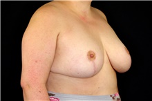 Breast Augmentation After Photo by Landon Pryor, MD, FACS; Rockford, IL - Case 45137